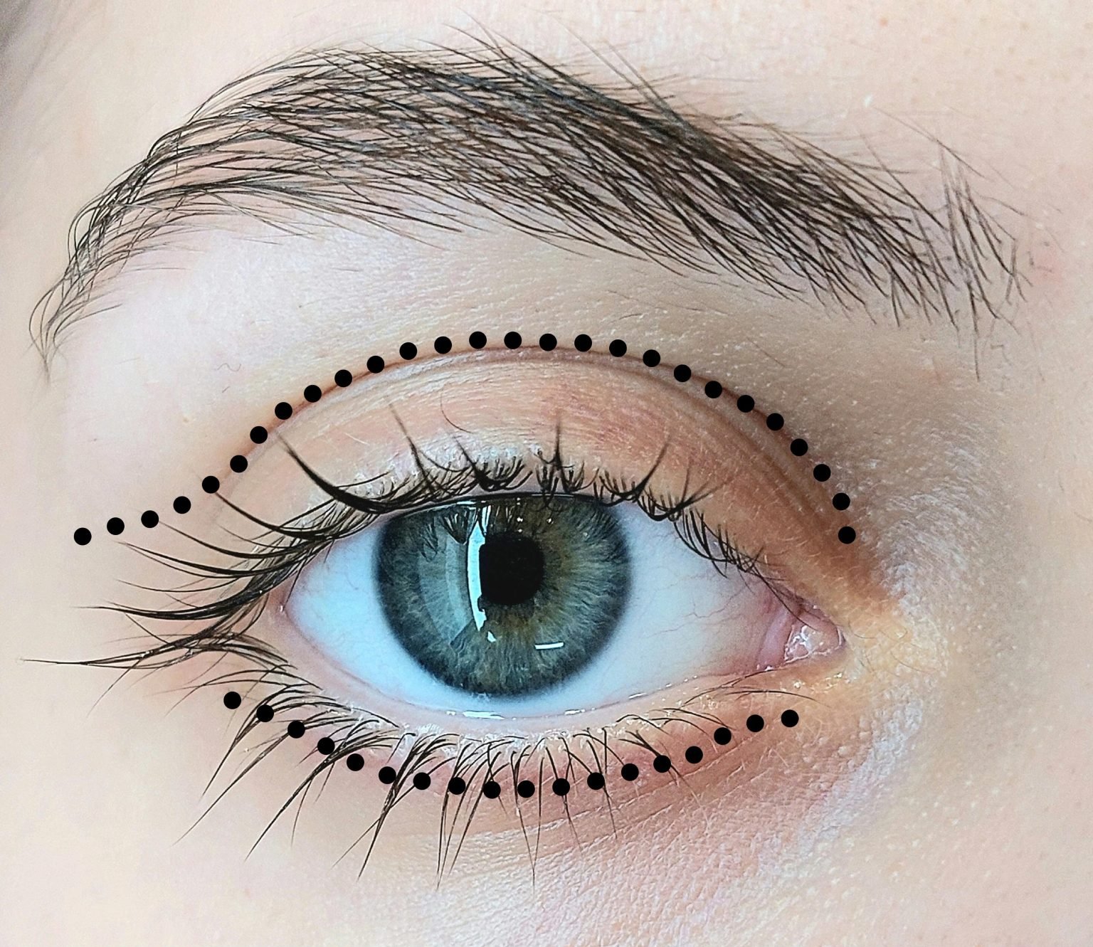 Blepharoplasty — upper and lower eyelid surgery