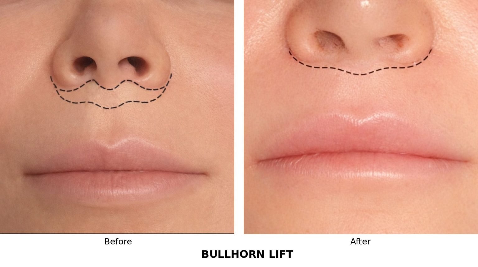Bullhorn lip lift — upper lip lift surgery